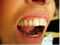 /album/galeria-de-fotos-carga-imediata-apos-exodontia-atraumatica-/carga-imediata-com-exodontia-atraumatica21-jpg/